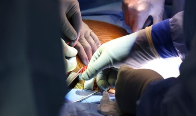 Patient who  had first ever pig kidney transplant dies two months after procedure