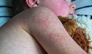 Measles cases worldwide almost double in a year - as England faces measles &#039;emergency&#039;