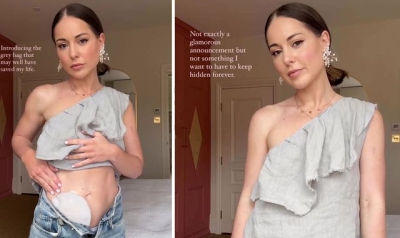 Louise Thompson reveals stoma bag after months of health problems: &#039;It may well have saved my life&#039;